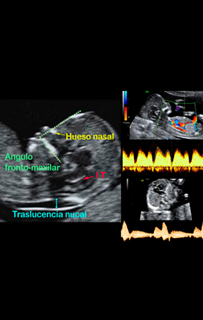 Ultrassom de marcadores